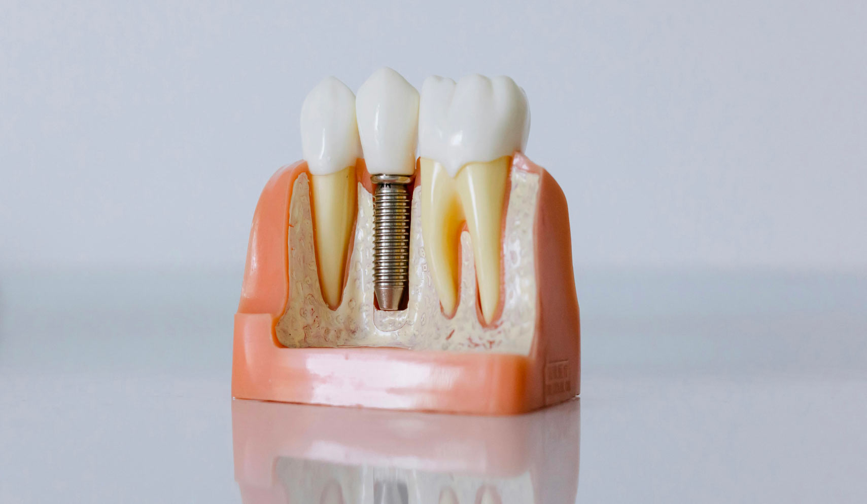 implants dentaires